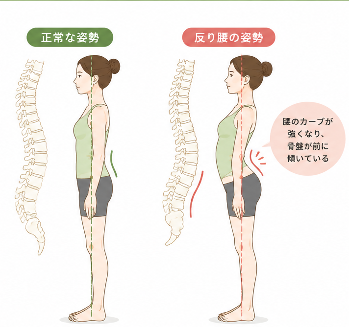 反り腰について